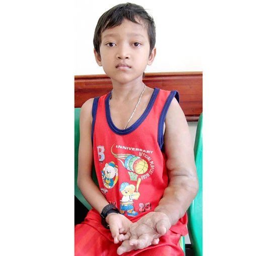 Cậu bé Khmer 11 năm bị bướu máu