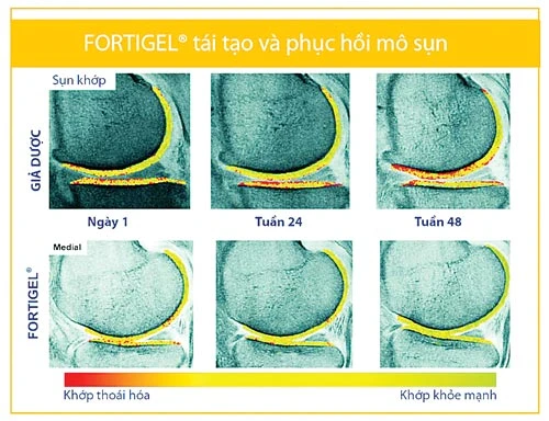 Ai có nguy cơ cao về tổn thương sụn khớp?