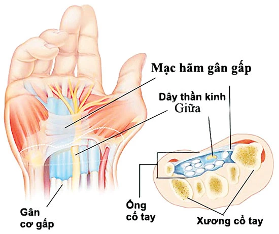 Phòng ngừa méo mặt, liệt chi chỉ vì bệnh tiểu đường