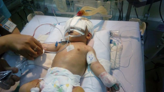 Phẫu thuật cứu trẻ sơ sinh bị dao đâm xuyên sọ não
