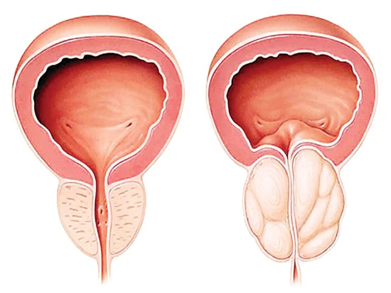 Phì đại tiền liệt tuyến - Tâm sự khó trải lòng