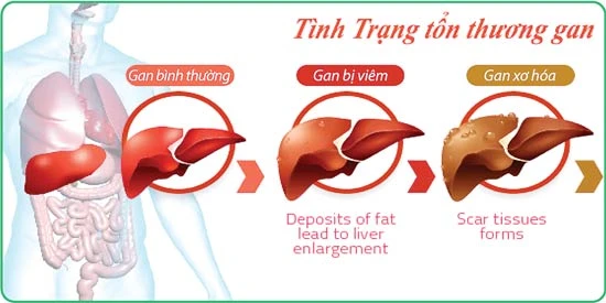 Báo động tình trạng viêm và xơ gan