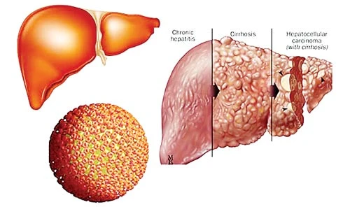 Diệt virus viêm gan để hạn chế ung thư gan