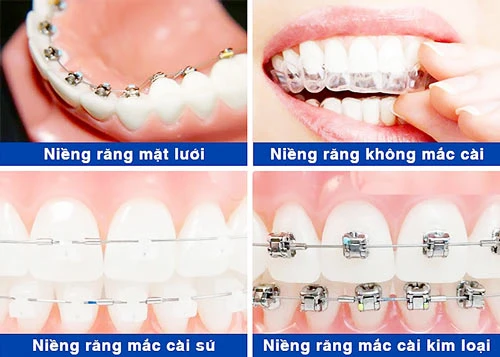 Những công nghệ niềng răng được ưa chuộng nhất