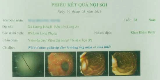 Nội soi lấy tăm tre đâm thủng ruột bệnh nhân