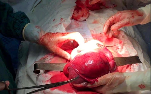 Hà Tĩnh: Phẫu thuật khối u xơ tử cung nặng hơn 6kg
