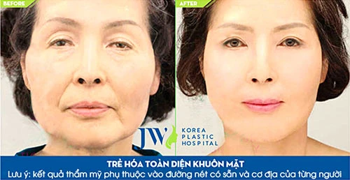 Ngày hội trị nám và trẻ hóa da toàn diện