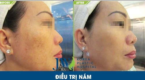 Giải pháp rút ngắn 1/2 liệu trình điều trị nám