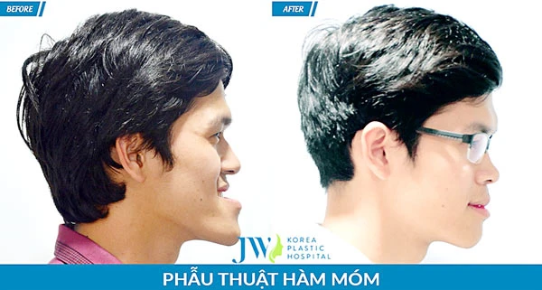 Chữa hô móm hai hàm bằng phẫu thuật