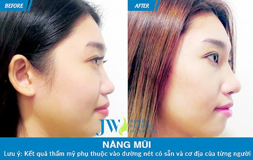 Nâng mũi S line - Giải pháp cho chiếc mũi trọn đời