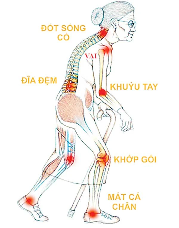 Đau xương khớp: Không rút độc, vĩnh viễn không khỏi