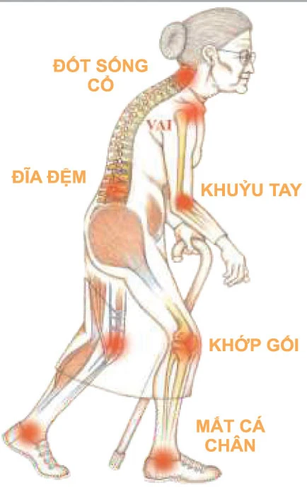 Đau xương khớp: Không rút độc, vĩnh viễn không khỏi