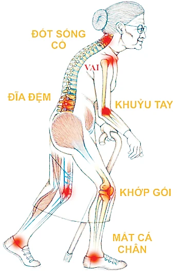 Đau xương khớp: Không rút độc, vĩnh viễn không khỏi