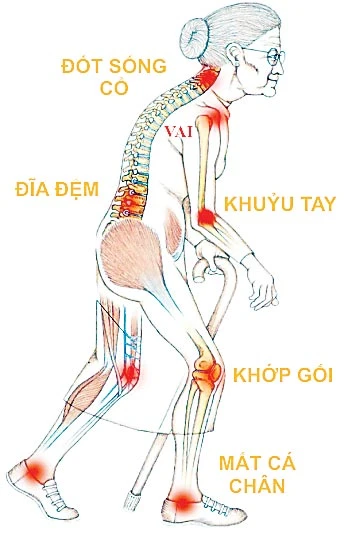 Đau xương khớp: Không rút độc, vĩnh viễn không khỏi