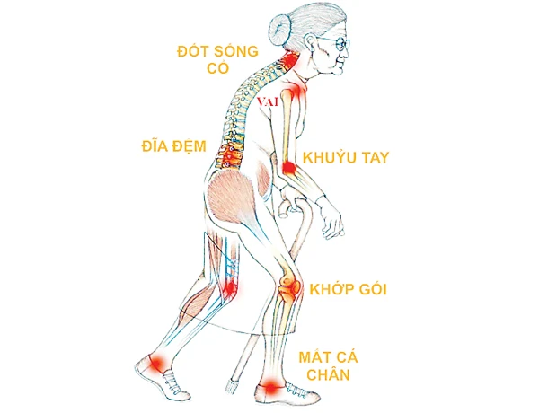 Đau xương khớp: Không rút độc, vĩnh viễn không khỏi