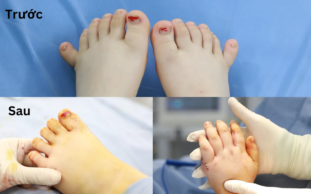 Một số hình ảnh tay chân cháu L. trước và sau khi phẫu thuật