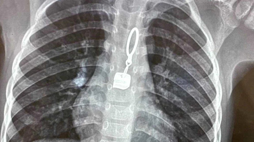 Hình ảnh dị vật chiếc khóa áo trong thực quản của bệnh nhân