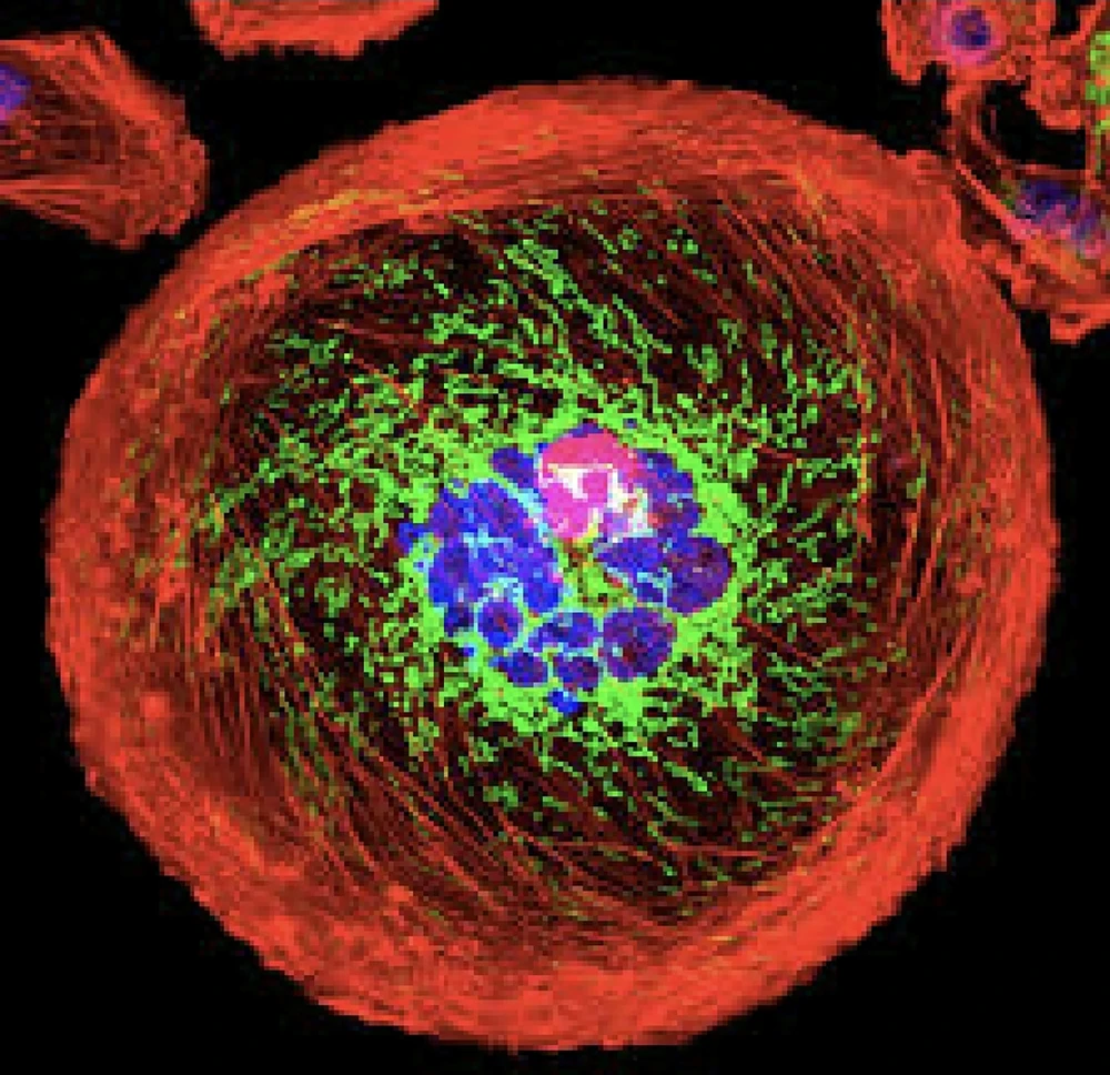 Hình ảnh một tế bào ung thư được nhuộm huỳnh quang