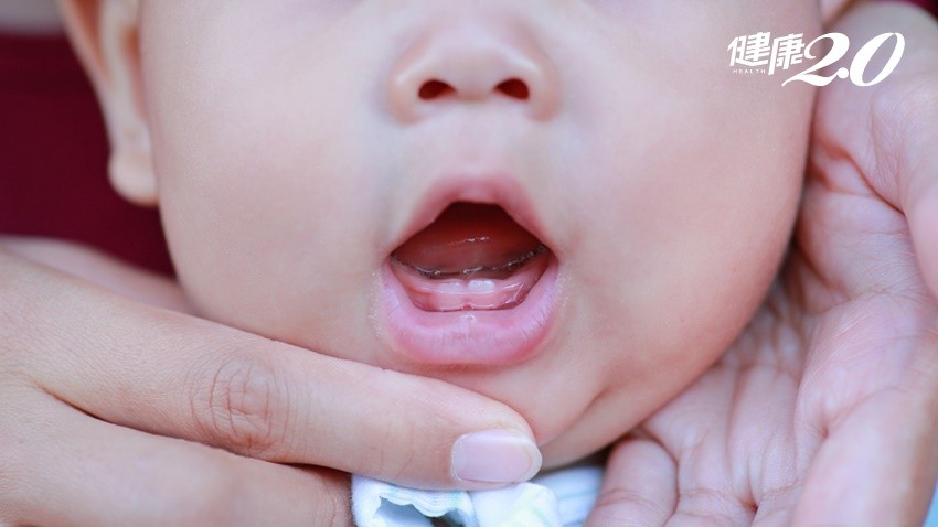 寶寶自帶牙出娘胎後換牙可能要矯正