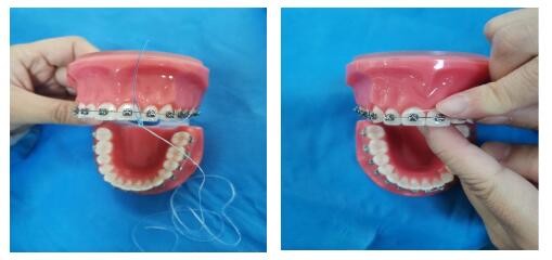 牙齿矫正期间控制牙菌斑方法