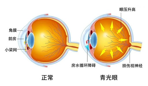 “视力小偷”症状隐蔽 眼科检查很有必要