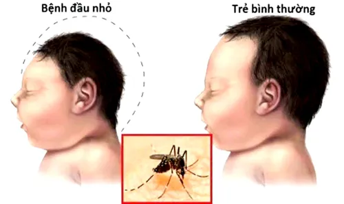 Phụ nữ mắc virus Zika sinh con dễ bị chứng đầu nhỏ. Phụ nữ mắc virus Zika sinh con dễ bị chứng đầu nhỏ.