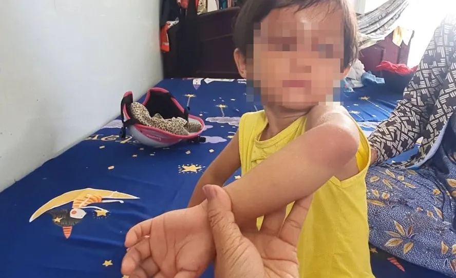 Bé gái 4 tuổi bị đánh đập thương tích nhiều vị trí trên cơ thể