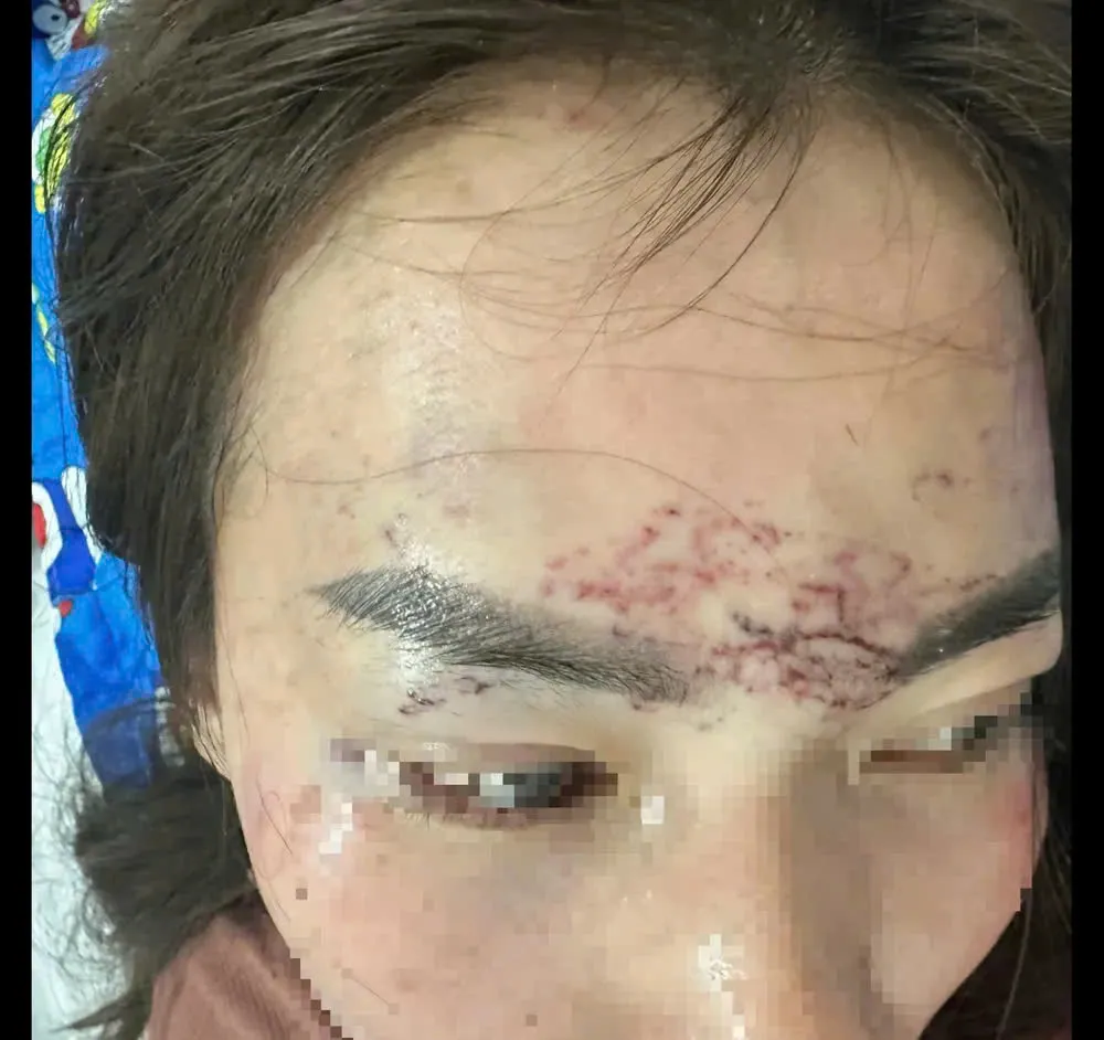 Chị P.H.M. bị hành hung và xăm lên mặt. ẢNH: CTV 3bb93a8caf6724397d76.jpg
