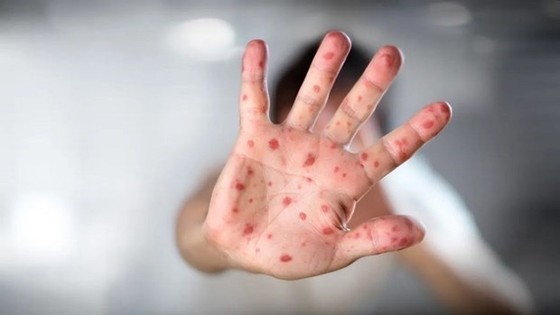 Of 20 monkeypox cases, 18 are diagnosed with B20 Of 20 monkeypox cases, 18 are diagnosed with B20
