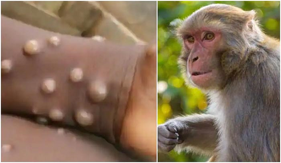 Vietnam likely to record more new monkeypox cases Vietnam likely to record more new monkeypox cases