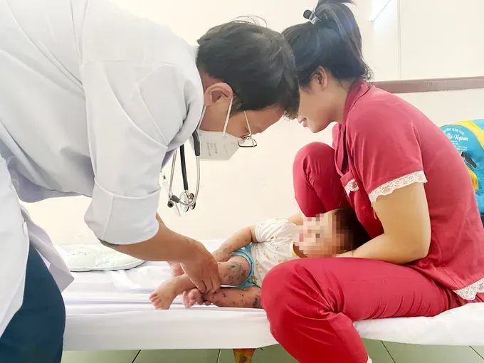 A doctor examines a child with hand-foot-mouth disease. tay-chan-mieng-2-xrjfjpg-6691.jpg