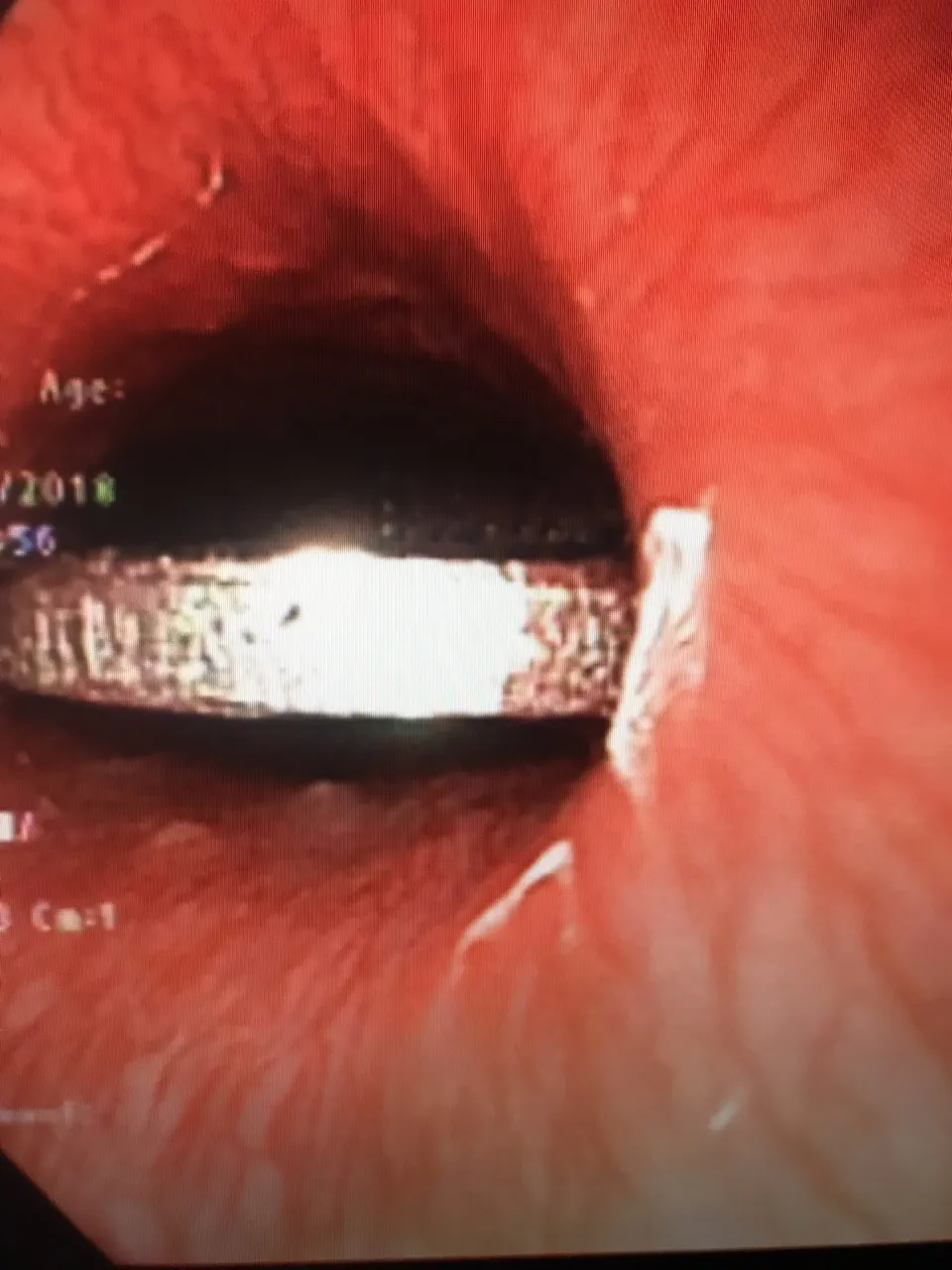 Vừa xem tivi vừa ăn, bé gái nuốt phải mảnh xương đùi gà ảnh 2 Vừa xem tivi vừa ăn, bé gái nuốt phải mảnh xương đùi gà ảnh 2