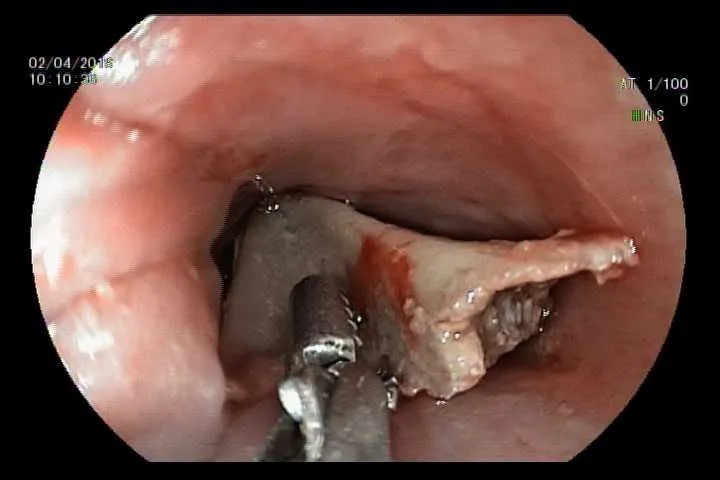Vừa xem tivi vừa ăn, bé gái nuốt phải mảnh xương đùi gà ảnh 1 Vừa xem tivi vừa ăn, bé gái nuốt phải mảnh xương đùi gà ảnh 1