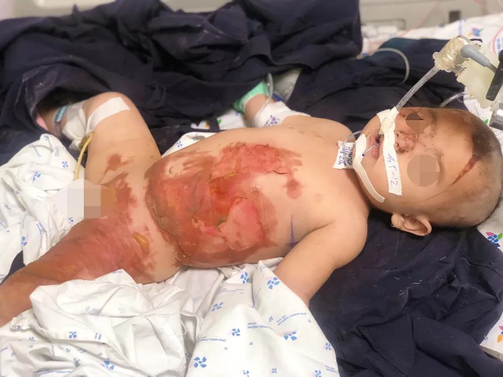 Cha mẹ bất cẩn, bé gái 20 tháng tuổi bỏng nước sôi thương tâm ảnh 1
