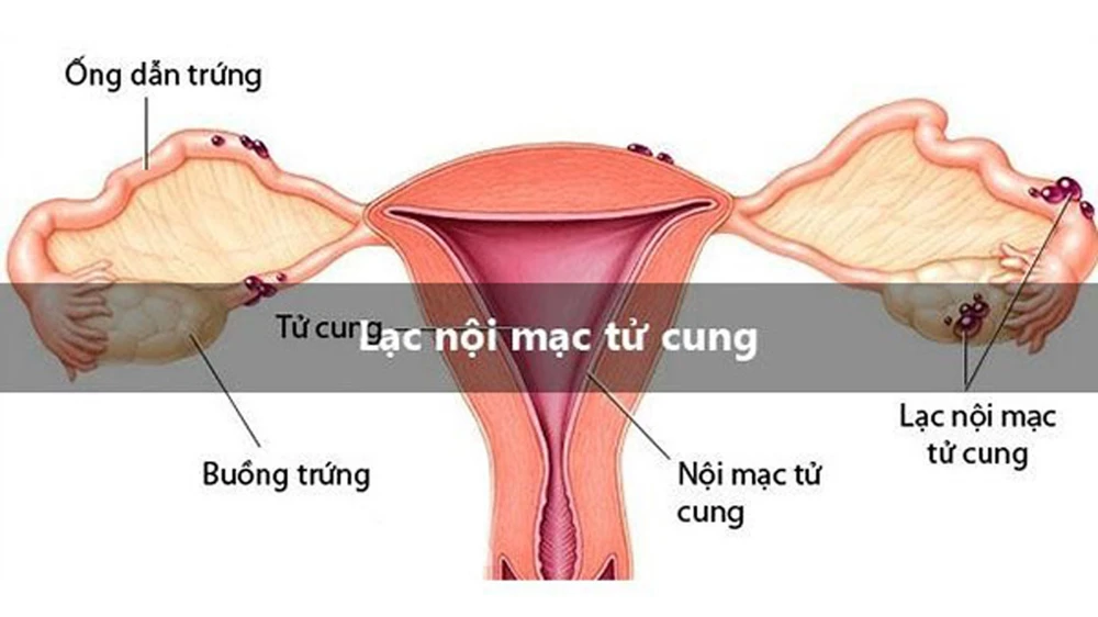 Lạc nội mạc tử cung - thủ phạm chính gây vô sinh