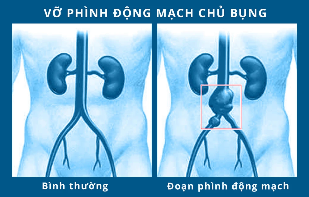 Cứu kịp thời cụ ông vỡ phình động mạch chậu chung 