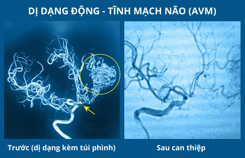 Hình ảnh chụp CT mạch máu não của bệnh nhân trước và sau khi can thiệp