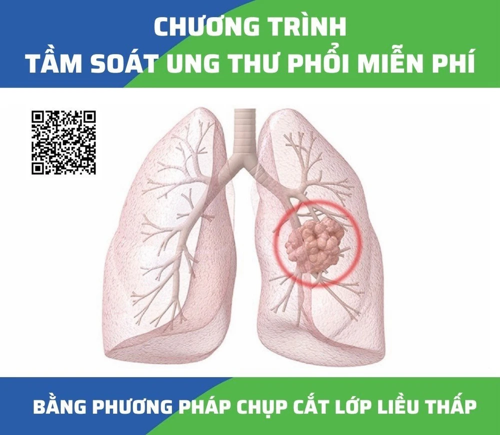 Khám, tầm soát ung thư phổi miễn phí 