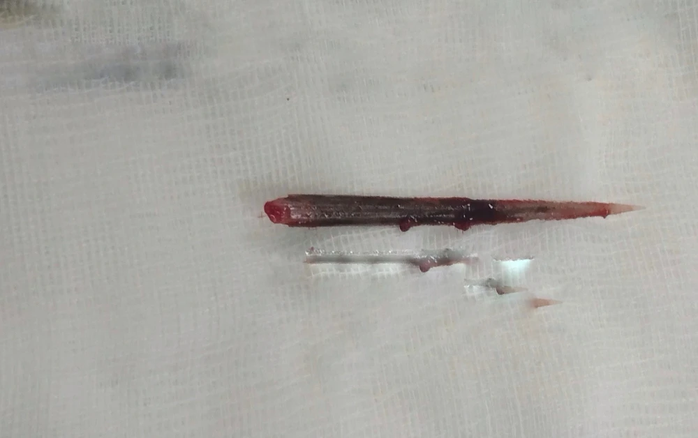 Dị vật là đoạn đuôi cá đuối dài khoảng 3,5cm với nhiều gai nhọn đuôi cá đuối