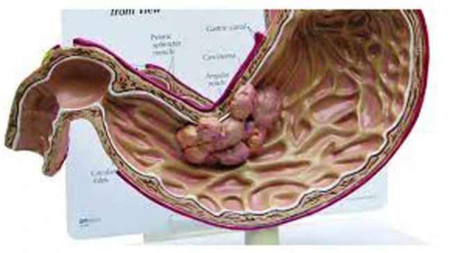 Hơn 15.000 ca ung thư dạ dày mỗi năm