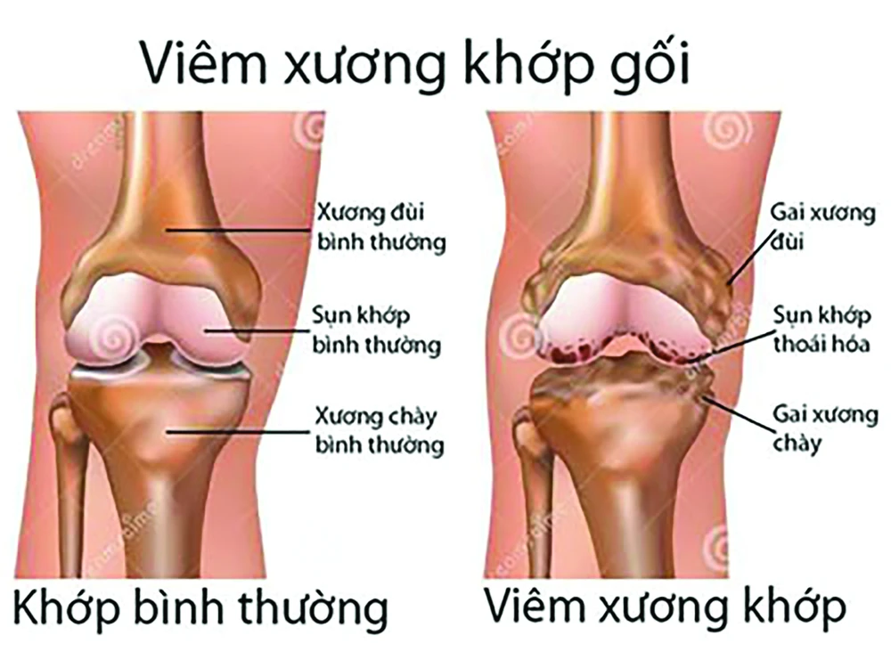 Từ biệt đau đớn do bệnh xương khớp