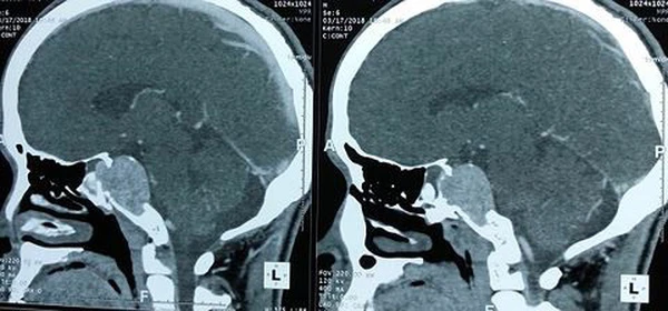 Nội soi qua mũi loại bỏ u não ở nền sọ