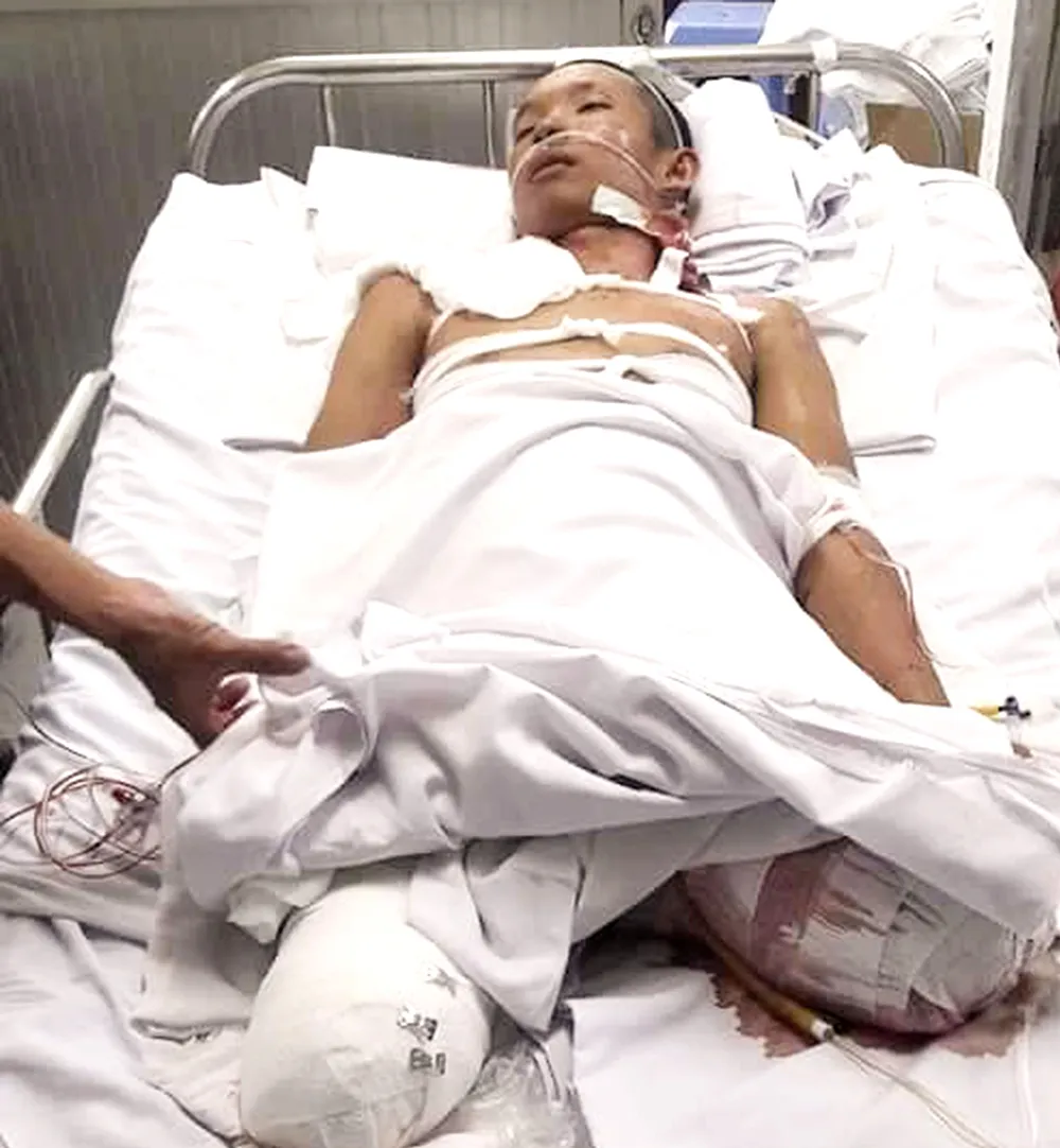 Một thanh niên nghèo bị tai nạn phải cắt bỏ 2 chân ảnh 1