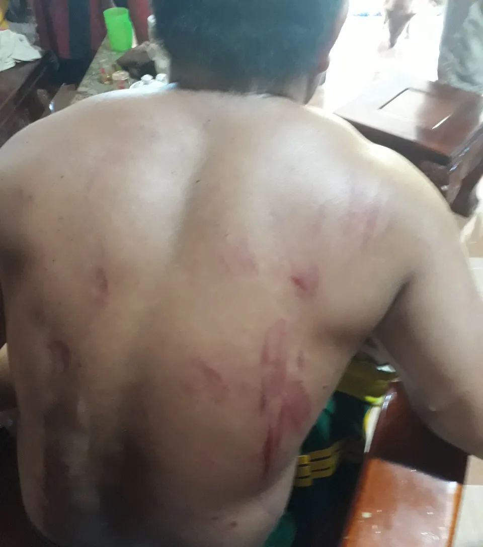 Người đàn ông bị chấn thương do voi tấn công Người đàn ông bị chấn thương do voi tấn công