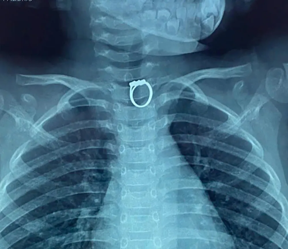 Phim chụp X-quang hiển thị chiếc nhẫn bị mắc kẹt trong thực quản bé gái