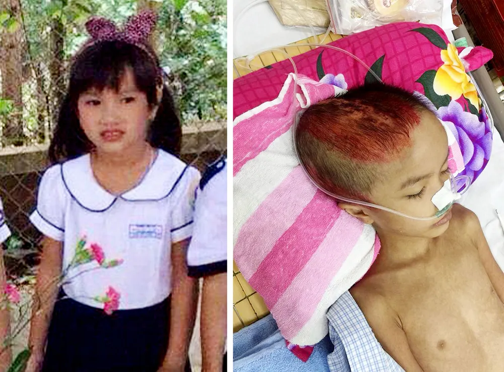 Bé 7 tuổi di chứng nặng sau tai nạn ảnh 1 Bé 7 tuổi di chứng nặng sau tai nạn ảnh 1