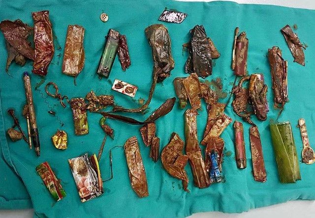 從該病人的胃部和消化管道中取出的大量異物。（圖源：白梅醫院）