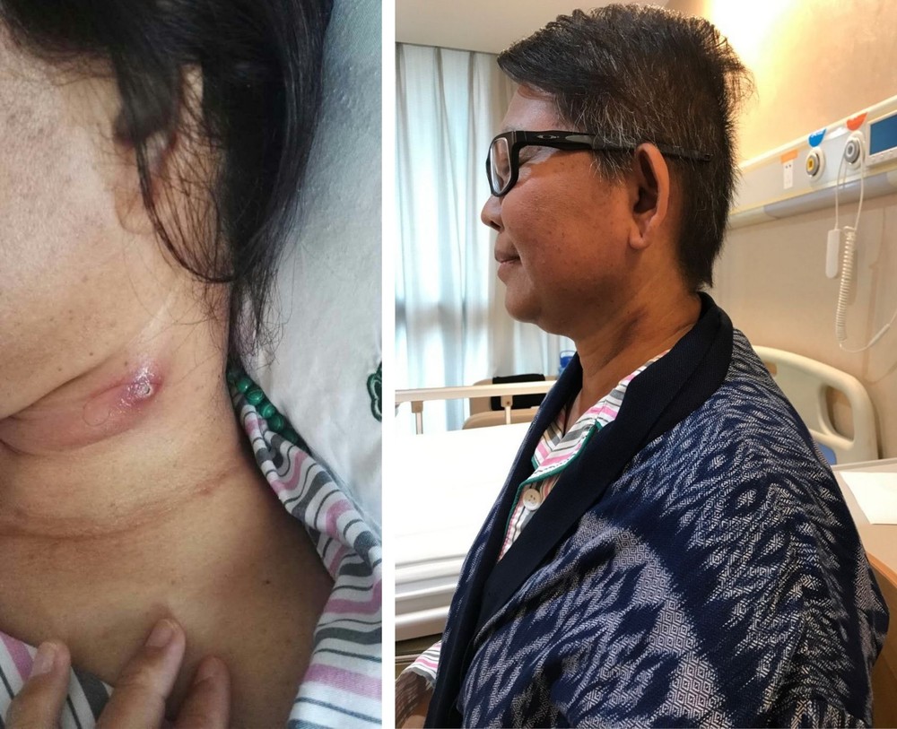 治療後頸部腫塊完全消失。