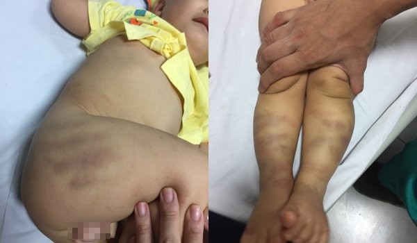 1歲多的男童遭虐待，送至醫院時遍體瘀傷。（圖源：互聯網）