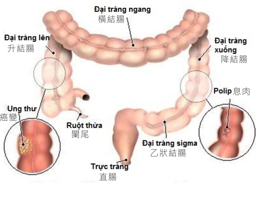 大腸癌發病例日增。（示意圖源：互聯網）